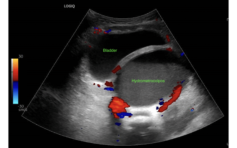 Ultrasound image showing hydrometrocolpos
