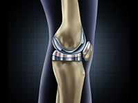 illustration of a knee replacement