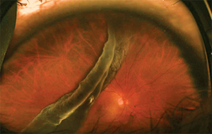 close-up of retina with a giant retinal tear