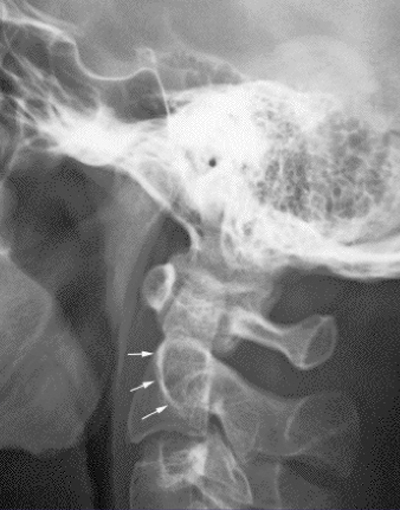 close-up x-ray of neck bones