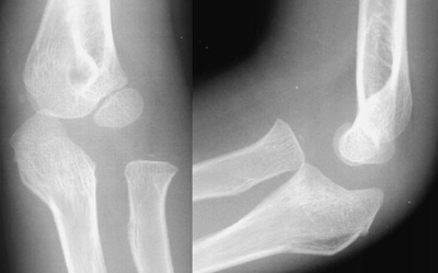 Close-up of x-ray of elbow