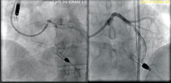 Stent and LVAD placement, Img01 and Img02