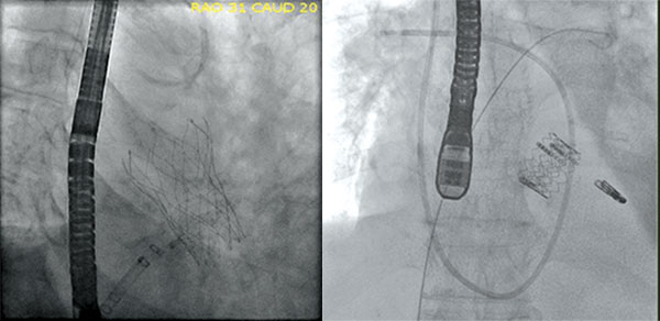  transcatheter aortic valve replacement, Img01 and Img02