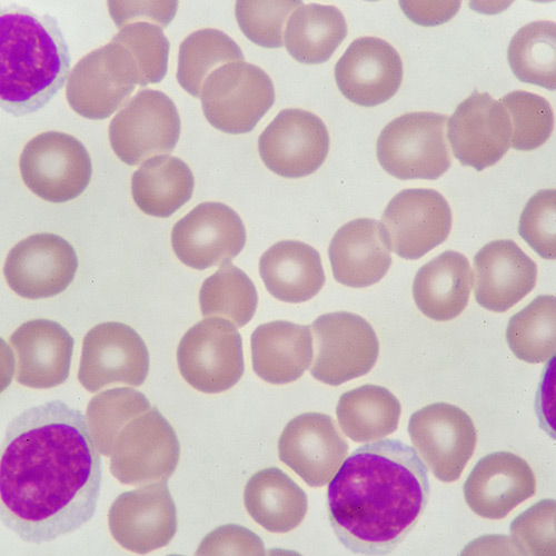 image of lymphotic leukemia blood smear