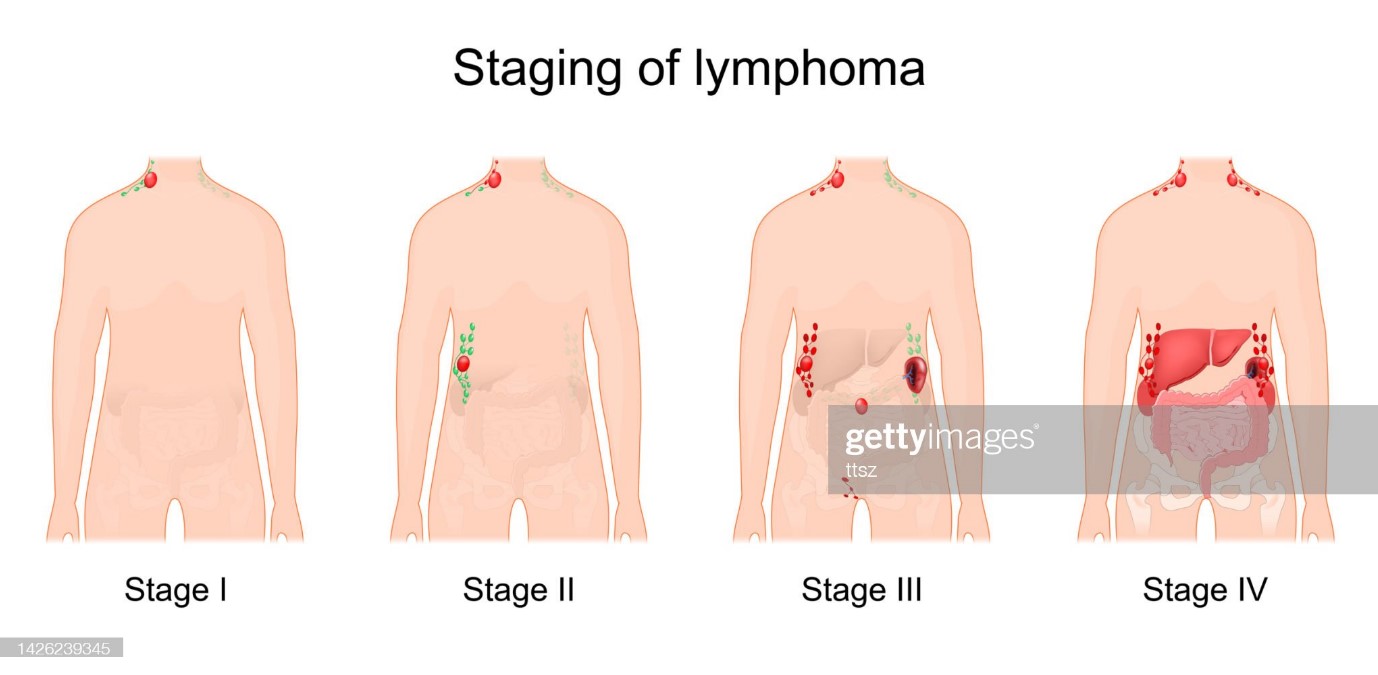 Diagram illustrating the worsening effects of cancer on the lymphatic system as the human body goes through the four stages of Hodgkin’s Lymphoma.