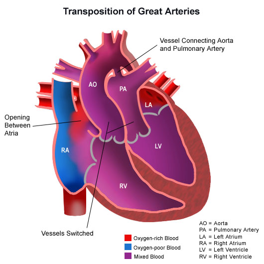 An Artist’s depiction of Transposition of Great Arteries 
