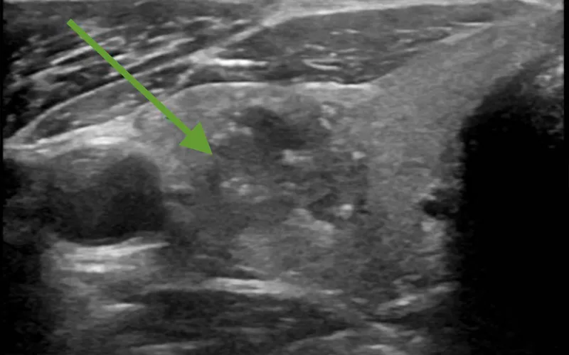 Neck ultrasound detection of right-sided thyroid cancer