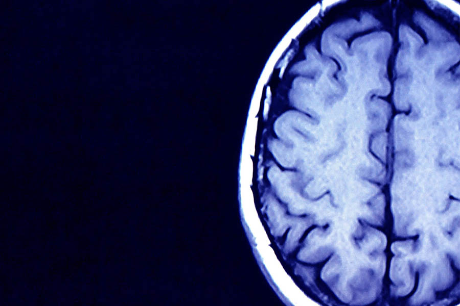 Novel Brain Study Uncovers Four Different Autism Subtypes
