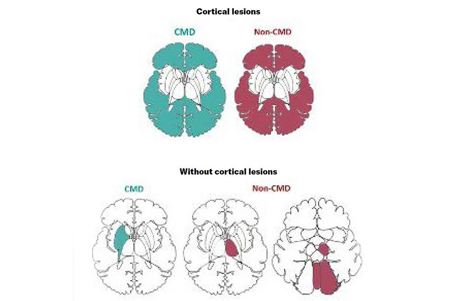 CMD (green) vs. non-CMD patients’ (red) anatomical distribution of lesion patterns on structural MRI.
