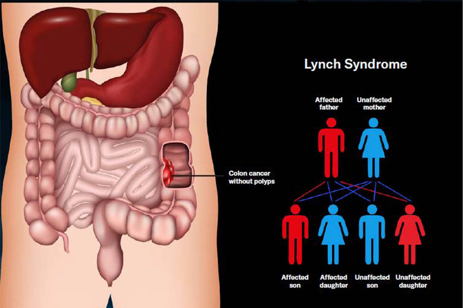 Diagram of Lynch syndrome.
