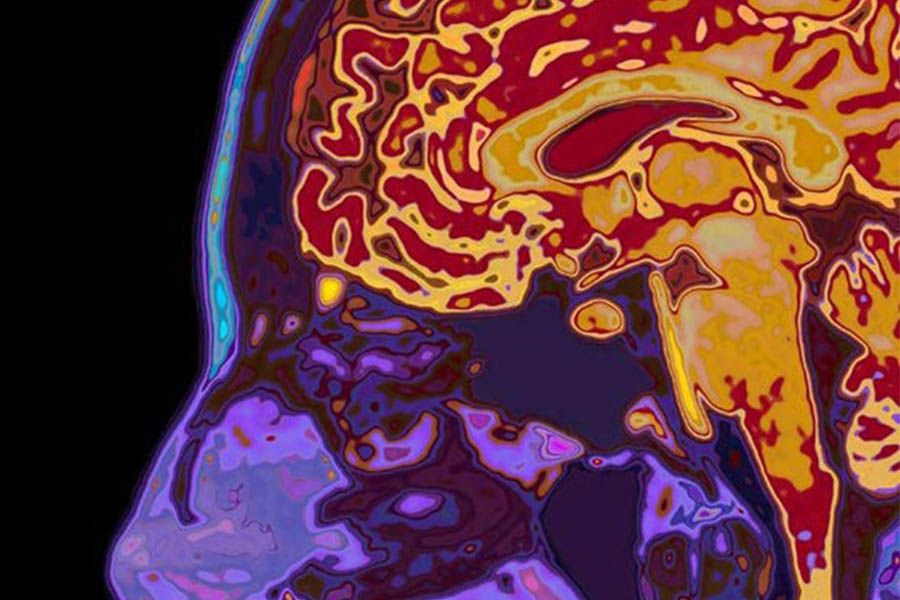 Novel Brain Study Uncovers Autism Subtypes