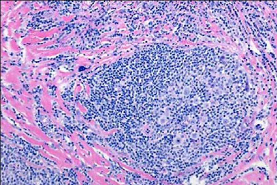 Hodgkin lymphoma biopsy demonstrating rare Hodgkin and Reed-Sternberg cells in a dense immune infiltrate. (Image courtesy of Dr. Lisa Giulino Roth)