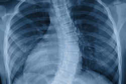 x-ray showing ribs of lungs