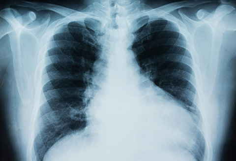 x-ray of chest