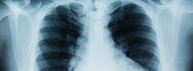 close-up x-ray of rib cage