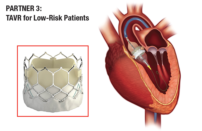 TAVR for Low-Risk Patients diagram of heart