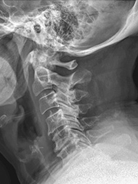 X-ray of cervical spinal stenosis in a patient with cerebral palsy