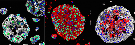 image of Organoids created from the bladder cancers of patients