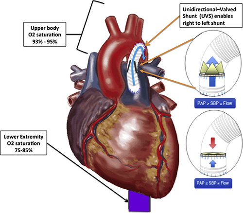 vector illustration of shunt in heart