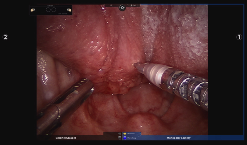 image of transoral robotic surgery