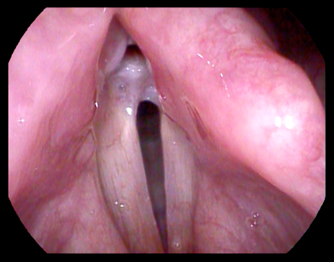 image of image of vocal folds in the throat