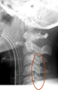 Close-up x-ray of neck bone