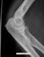 Elbow X-Ray Image