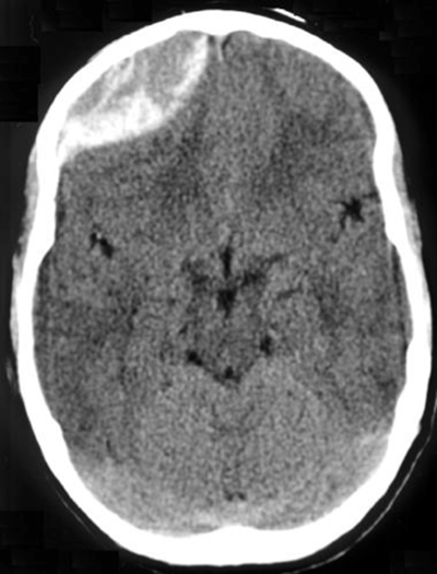 Cat Scan Brain Tumor