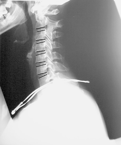 close-up x-ray of cartilage disks