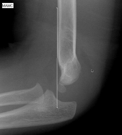 Elbow fracture