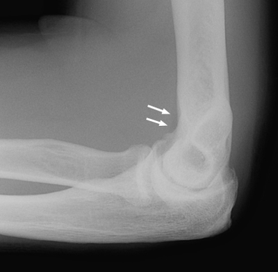 Close-up x-ray of elbow