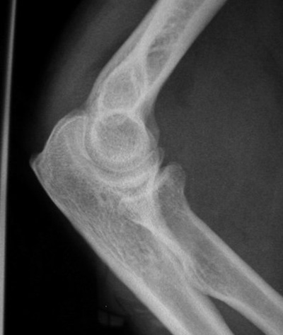 radial head fracture