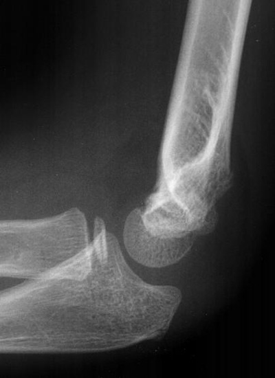 Close-up x-ray of elbow