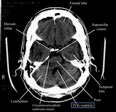 Labeled CT scan of brain