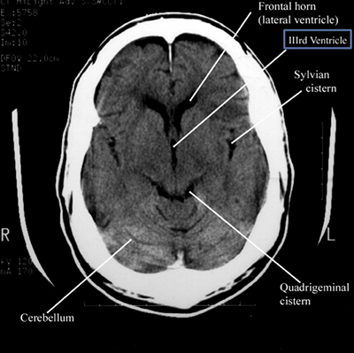 Labeled CT scan of brain