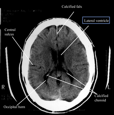 ventricles_lateral