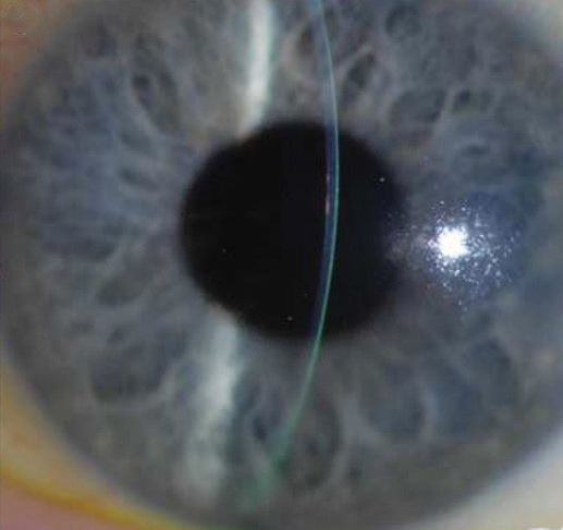 Postoperative image of the eye following DMEK