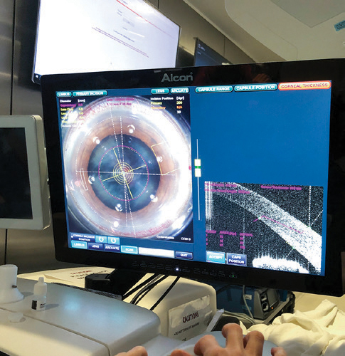 image of monitor showing noninvasive femtosecond laser-assisted cataract surgery