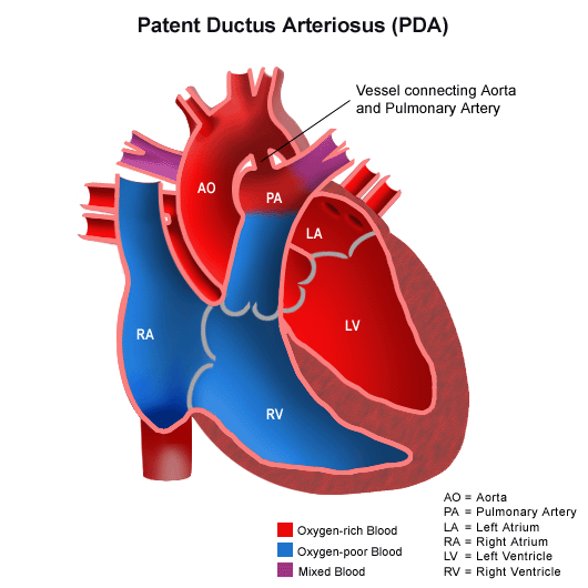 Illustration of the human heart with a patent ductus arteriosus
