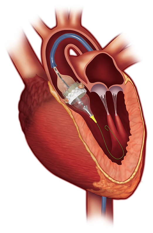 Sapien 3 aortic valve