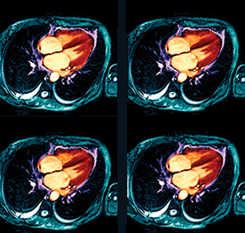 MRI image of transcatheter mitral valve replacement
