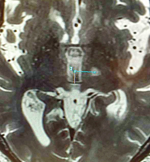 high-intensity focused ultrasound