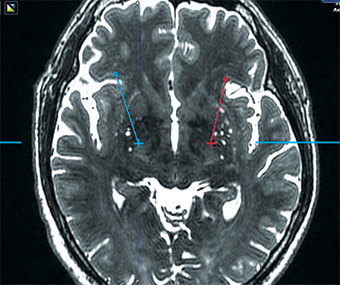 diffusion tensor imaging