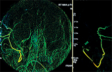 middle meningeal arterial embolization