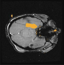 laser interstitial thermal ablation therapy