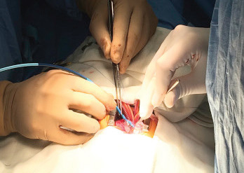 positioning the valve through mitral annulus