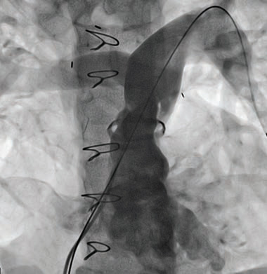 Pre-transcatheter Pulmonary Valve Replacement X-ray Image