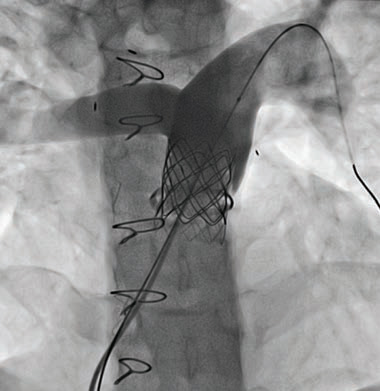 Post-transcatheter Pulmonary Valve Replacement X-ray Image