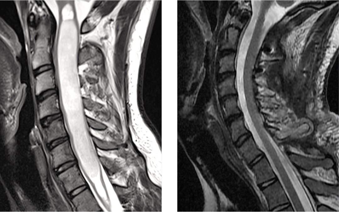 Spine Care Treatment & Services | Och Spine Hospital | NewYork-Presbyterian