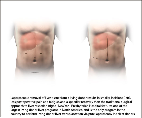 diagram of body showing where laparoscopic removal happens  